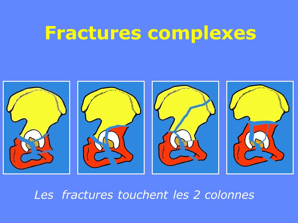 Fractures Du Cotyle Ou Fractures De Lac Tabulum Ppt Video Online